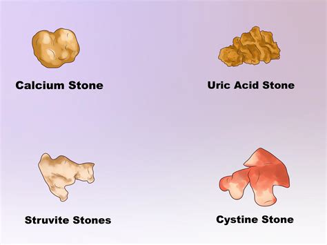 How Big is a 2mm Kidney Stone and Why Does It Feel Like a Boulder in Your Ureter?